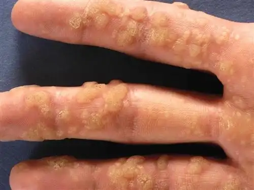 寻常疣的早期症状