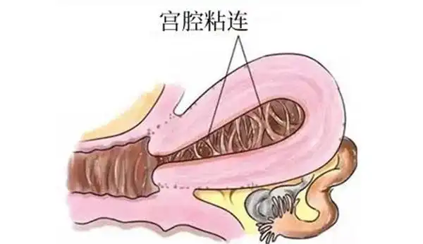 5%,尤其是重度宫腔粘连,复粘率可高达62.