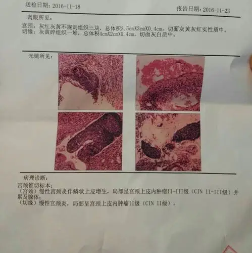 宫颈锥切标本: (宫颈)慢性宫颈炎拌鳞状上皮增生,局部呈宫颈上皮内