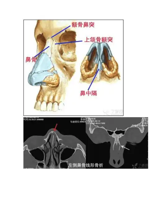 鼻骨骨折诊断误区