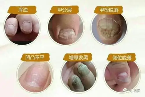 怎么自己辨别得了灰指甲