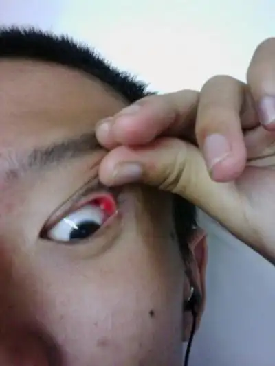 眼结石图片 (33)