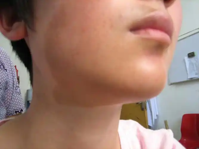 楼主hebeilhq2009-07-10 18:19:37贝克尔痣(becker nevus)又称为