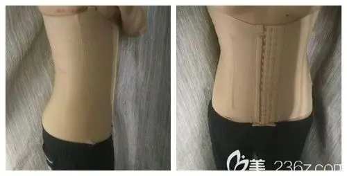 术后半个月穿着塑身衣腰腹部吸脂恢复情况
