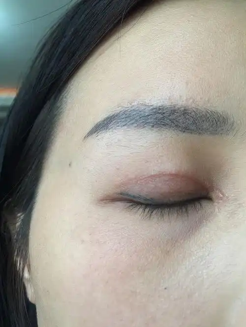 割双眼皮开眼角 4个月了增生