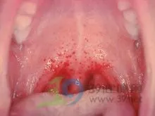 腭部可见小出血点