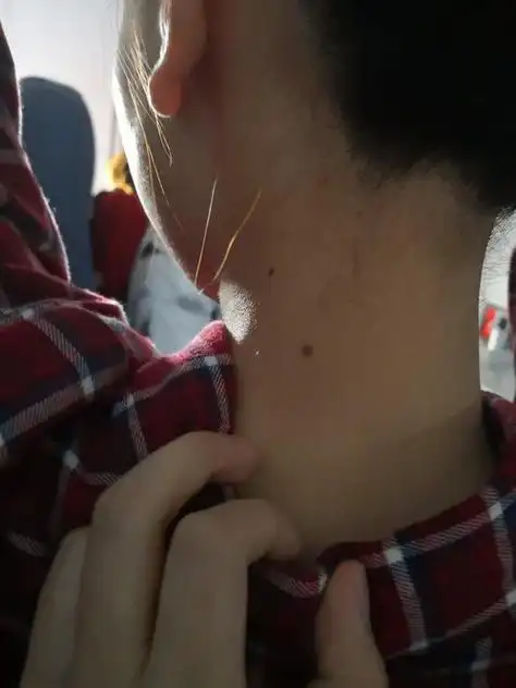 女人脖子后面有痣图解脖子后面有痣命运如何