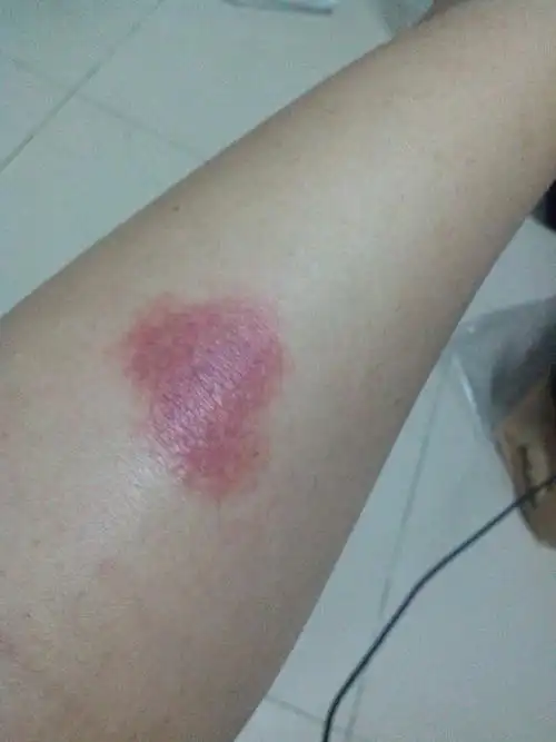 腿上红肿,又疼又痒,刚开始只是痒,微红,表面有透明小水泡,水_皮肤科