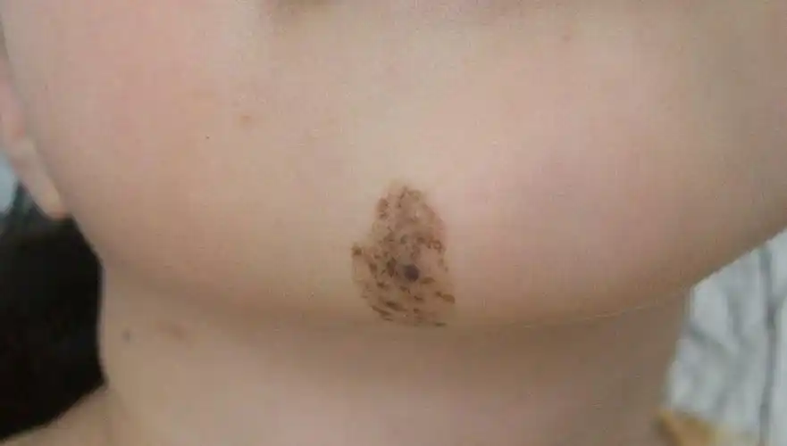 病理上与咖啡斑基本相同;"痣"可以是皮内痣,混合痣,交界痣,雀斑样痣等