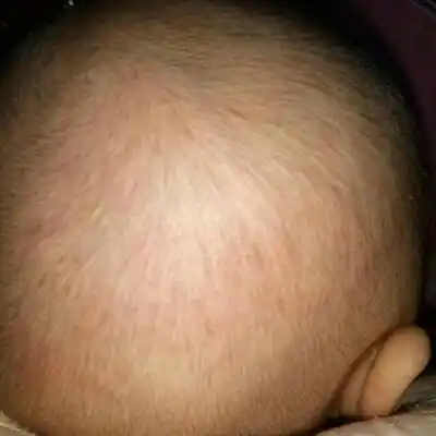 两个月宝宝头上起小红痘痘是怎麼回事