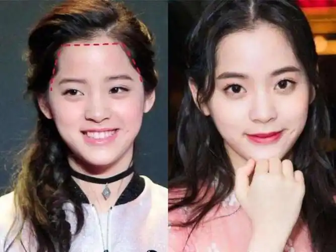 把刘亦菲的发际线修成娜扎的样子,神颜竟成了大饼脸?