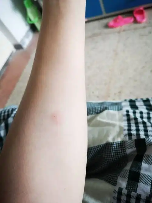 前天做了皮试(肺结核),这样正常吗