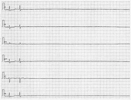 我前天在家做的24小时动态心电图,报告出来后显示我有几次心脏停搏2秒