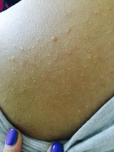 问:张在背上,不痛不痒,时间很长了,平时都没怎么