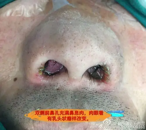 双侧鼻腔满满的鼻息肉