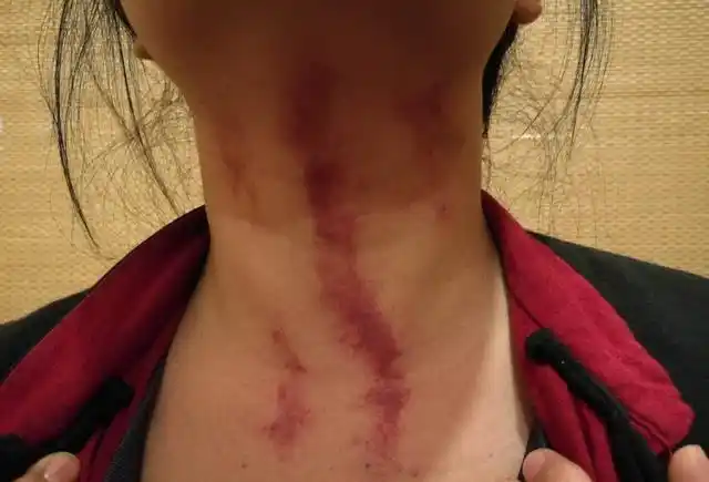 当然小编是没有用过自己唾沫揪痧的.