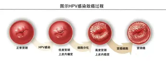 妇科医生告诫宫颈癌发病率高这样补充营养抵抗hpv病毒入侵