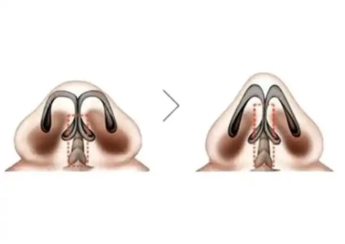 鼻小柱延长怎么缩小鼻翼