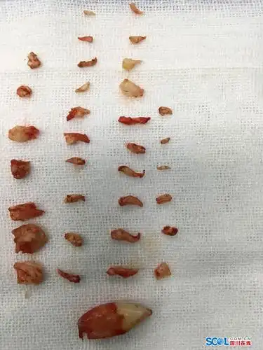 绵阳市三医院颌面外科成功治愈一牙瘤患儿