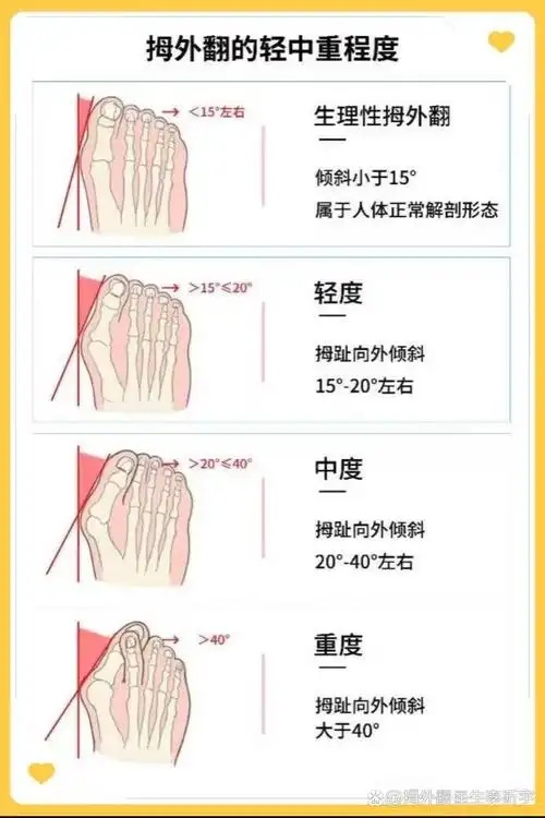 你是否发现,身边有些人的脚大拇指总是歪向一边,和其他脚趾挤在一起