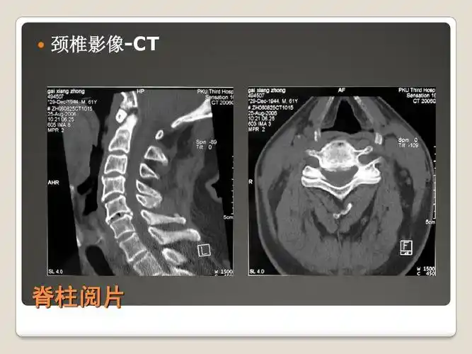 颈椎影像-ct 脊柱阅片