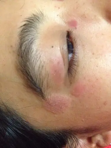 如图,怀孕五个月了,眼睛周围起的东西,起皮,而且有时痒