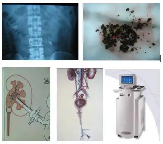 钬激光碎石术—— 泌尿外科新武器_手机搜狐网