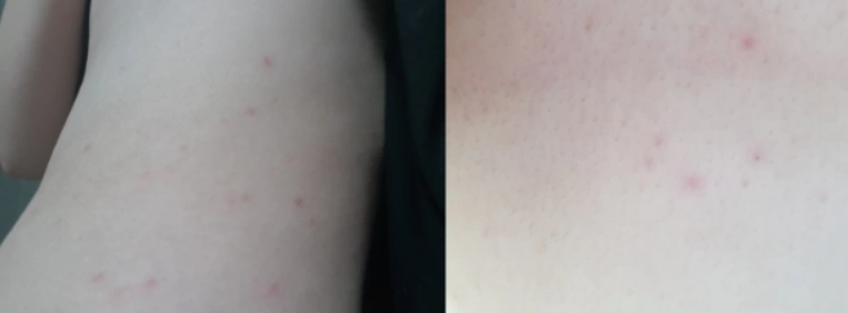 螨虫叮咬后的症状图人身上被螨虫咬的图片螨虫怎么去除