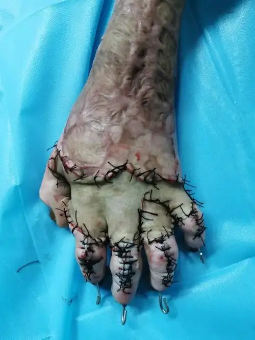 蒋医生健康科普-手背烧伤后疤痕增生(瘢痕)爪形手挛缩畸形(图文解读)