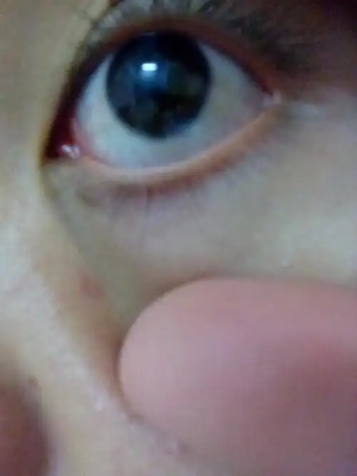 圆球周围的眼白发黄这是怎么了