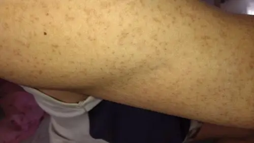 胳膊皮肤上有红点,斑点.