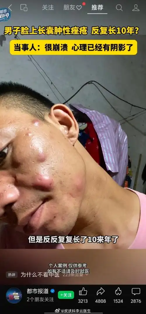 a酸软胶囊同时可联合类固醇激素快速压制炎症囊肿性痤疮照片痤疮图片