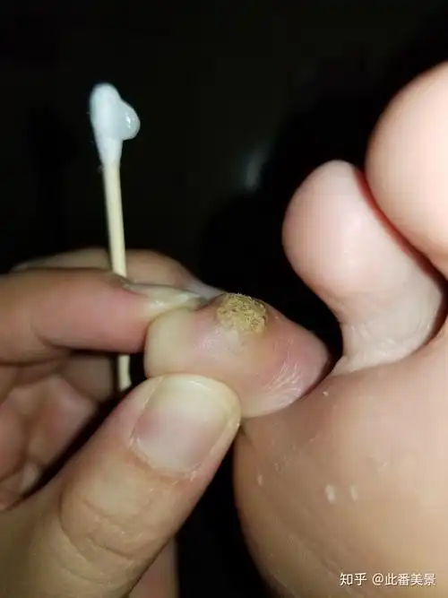 我的跖疣治疗经历(带图慎点)