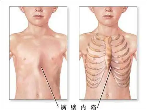 于是,他们坚持补钙了3年,可不但没有好转,胸部的凹陷还越来越深了