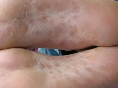 二期梅毒患者可出现斑疹性梅毒疹,即可表现为在两个脚心上出现大片的