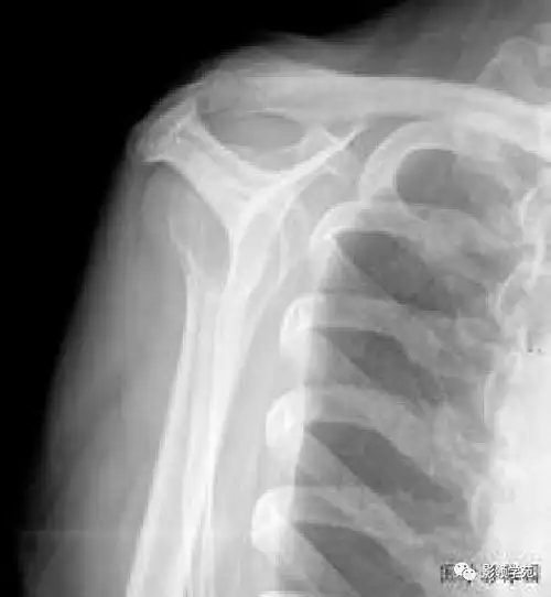 冈上肌出口位影像学检查