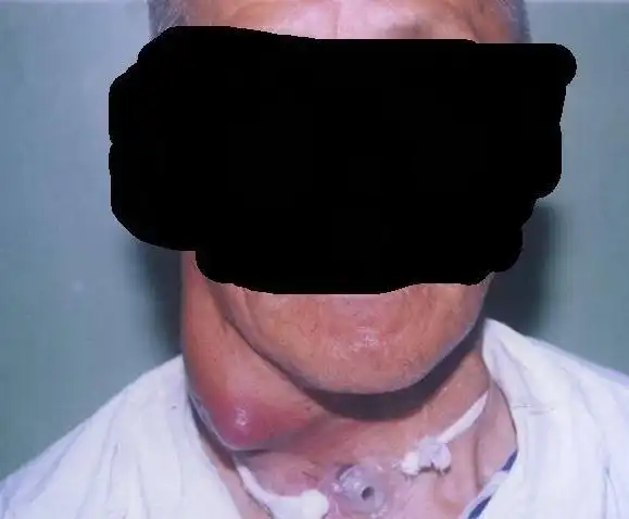 颈部淋巴结转移癌