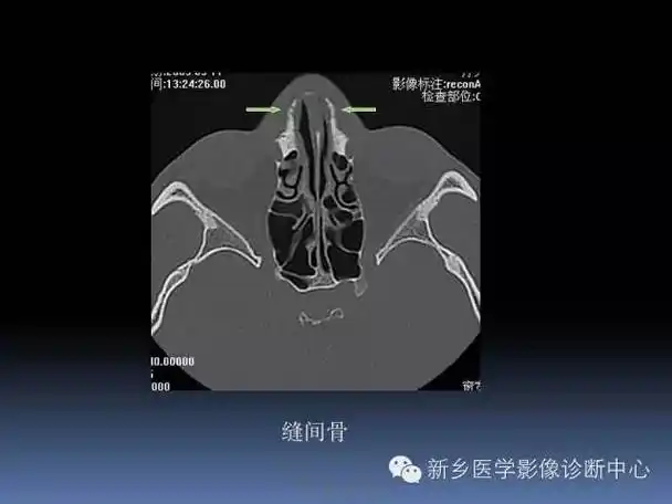 写鼻骨骨折ct报告,一定要了解的解剖