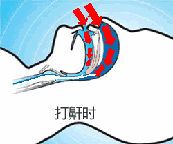 一夜"断气"389次!最长一次85秒!这种"生命杀手"千万别忽视!