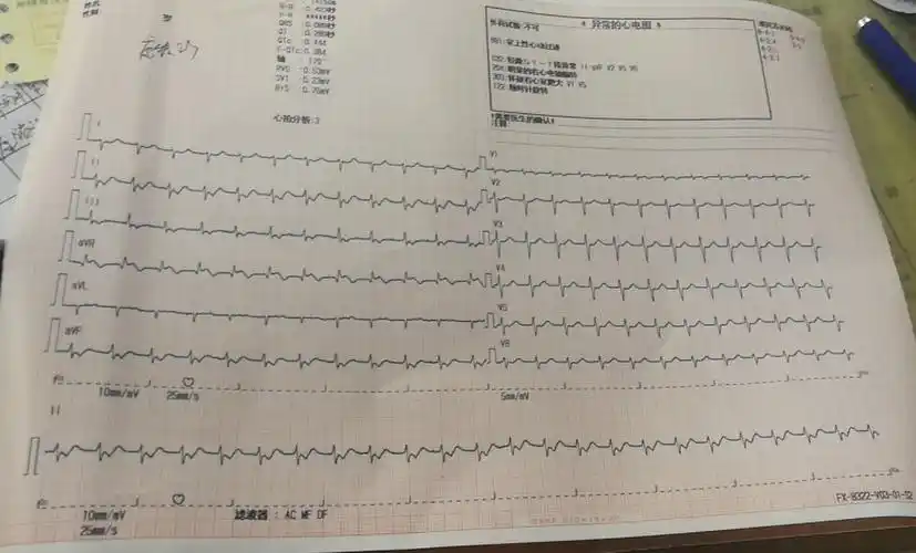 入院后心电图示室上性心动过速