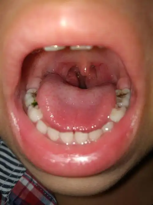 五岁宝宝嗓子老是嘶哑发炎怎么回事,请问一有何方法,下有配图谢谢!