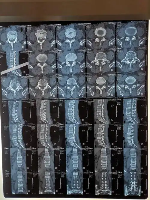 微创治疗脊柱骨折