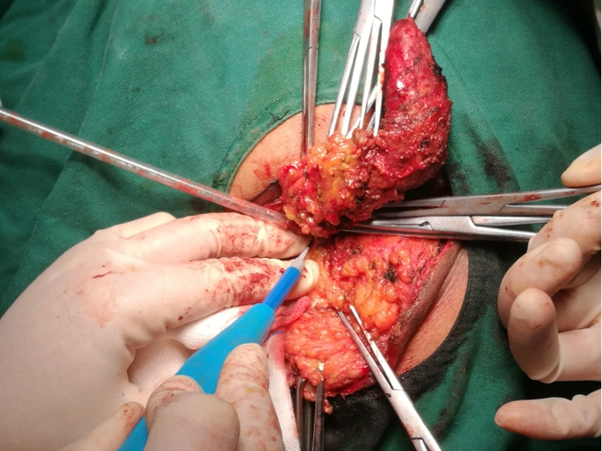 肛周表皮样囊肿病例报道1例