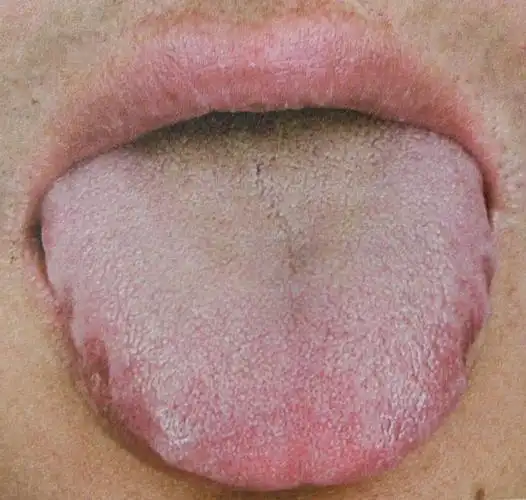 舌头胖大,有齿痕,舌上有两条唾液线,说明体内湿气很重 如果舌苔都浮起
