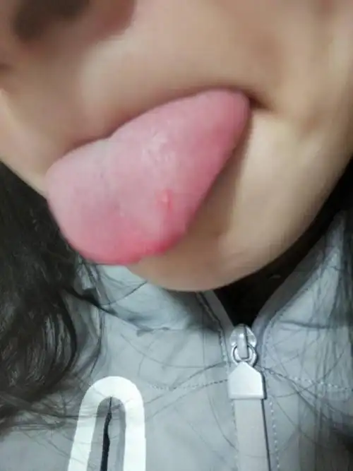 舌头上起了泡,啥原因啊