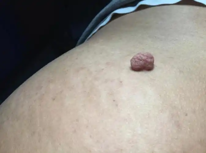 乳房上长了小肉粒图片(脖子和腋下的) - 赤虎壹号