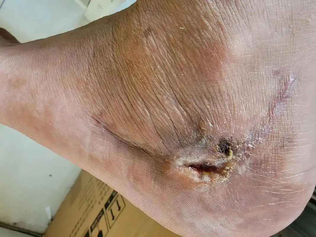 跟骨骨折术后4个月伤口中间2㎝不愈合!恳请全网那位高人指点迷 - 抖音