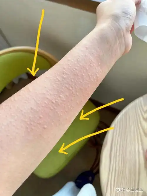 请问手臂上起的红疙瘩,一片,是怎么回事?