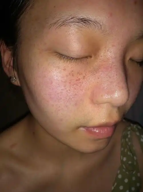 用了挺长时间了,脸上的斑真的有在变淡,肉眼看得