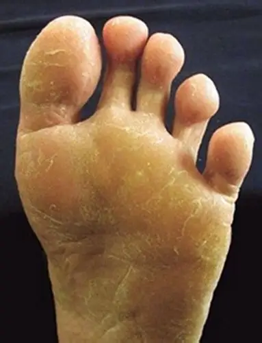 严重脚气病脚图片_有来医生